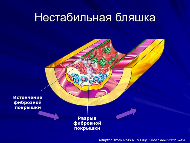 Adapted from Ross R. N Engl J Med 1999;362:115–126 Нестабильная бляшка Разрыв фиброзной покрышки